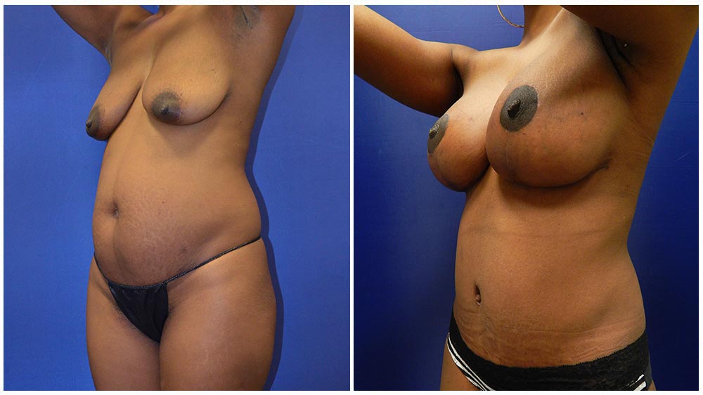 Fat Transfer Breast Augmentation Patient (38 Years)